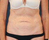 Type 2 Tummy Tuck - before