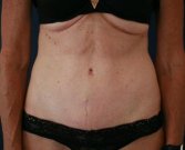 Type 2 Tummy Tuck - after
