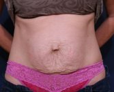 Tummy Tuck Times Two - before