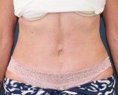 Tummy Tuck Times Two - after