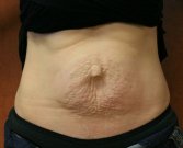 Tummy Tuck Scar - before