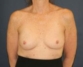 Ruptured Breast Implants - before