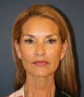 Preventive Face and Neck Lift - before