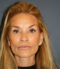 Preventive Face and Neck Lift - after