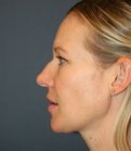 Nose Surgery 228 - before
