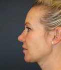 Nose Surgery 228 - after