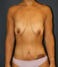 Makeover After Weight Loss - before