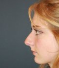 Rhinoplasty California - before