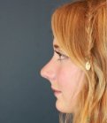 Rhinoplasty California - after