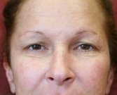 Blepharoplasty Case 29 - before