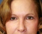 Blepharoplasty Case 29 - after