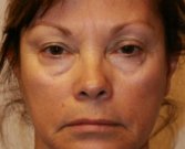 Blepharoplasty Case 30 - before