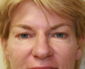 Blepharoplasty Case 31 - before