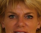 Blepharoplasty Case 31 - after