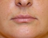 Lips Case 1 - before