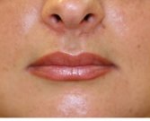 Lips Case 1 - after