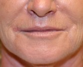 Lips Case 3 - after