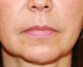 Lips Case 5 - before
