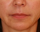 Lips Case 5 - after