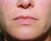 Lips Case 6 - before