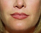 Lips Case 6 - after