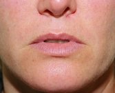Lips Case 7 - before