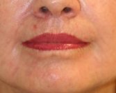 Lips Case 8 - after