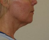 Necklift case 8 - before