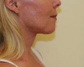 Necklift case 8 - after