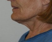 Necklift case 9 - before