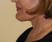 Necklift case 9 - after