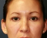 Blepharoplasty Case 33 - after