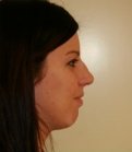 Rhinoplasty case 22 - before