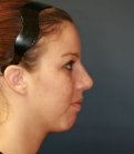 Rhinoplasty case 22 - after