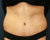 Tummy Tuck Case 29 - after