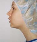 Chin Case 1 - before