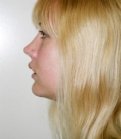 Chin Case 1 - after