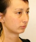 Chin Case 3 - before