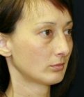 Chin Case 3 - after
