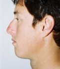 Chin Case 4 - before