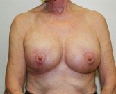 Breast Reduction Case 1 - after