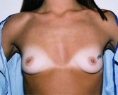 Breast Augmentation Case 2 - before