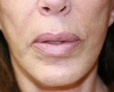 Lips Case 12 - before