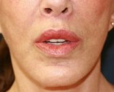 Lips Case 12 - after