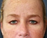 Blepharoplasty Case 36 - before