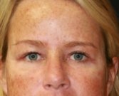 Blepharoplasty Case 36 - after