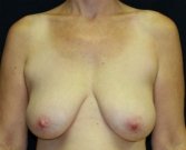 Breast Lift Case 10 - before