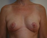 Breast Lift Case 10 - after