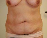 Mommy Makeover San Diego Case 3 - before