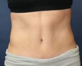Tummy Tuck San Diego Case 31 - after